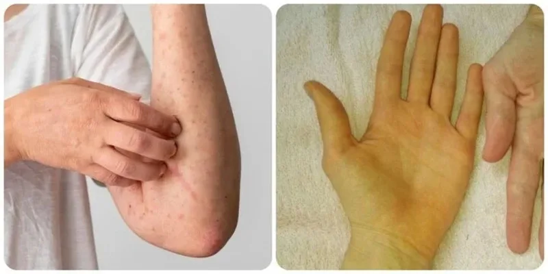 Vàng da, bụng trướng, phù chân hoặc xuất huyết tiêu hóa là những dấu hiệu cần được đánh giá y tế sớm.