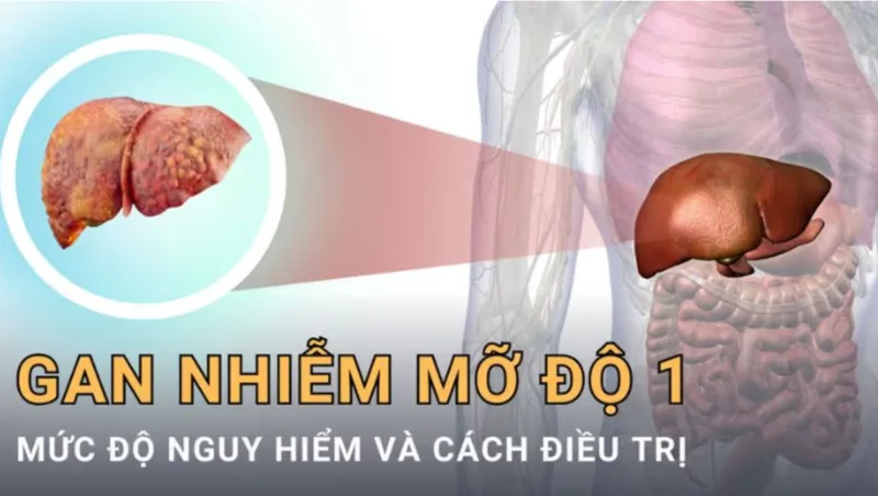 Gan nhiễm mỡ độ 1 thường mô tả tình trạng mỡ tích tụ trong gan ở mức độ nhẹ trên hình ảnh siêu âm.