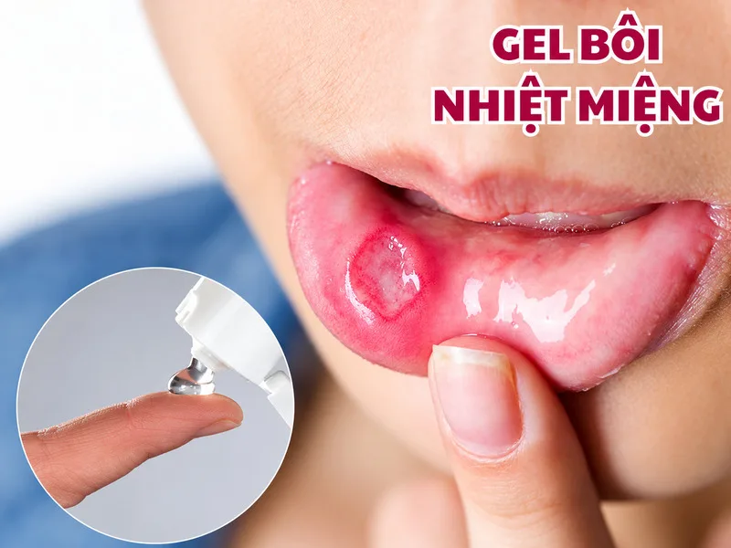 Gel bôi nhiệt miệng giúp bảo vệ niêm mạc và giảm cọ xát